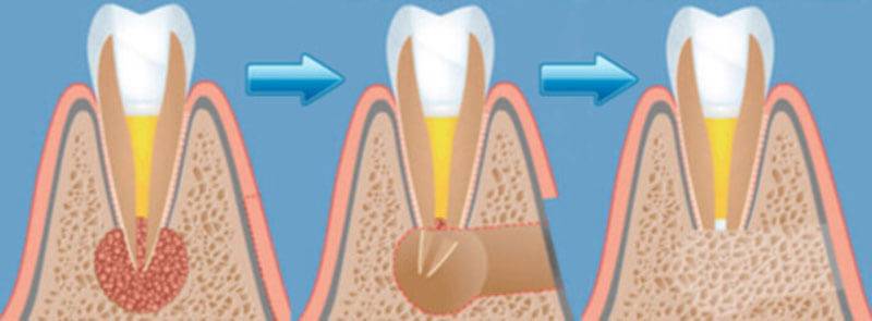 цистэктомия зуба, цистэктомия зуба шымкент